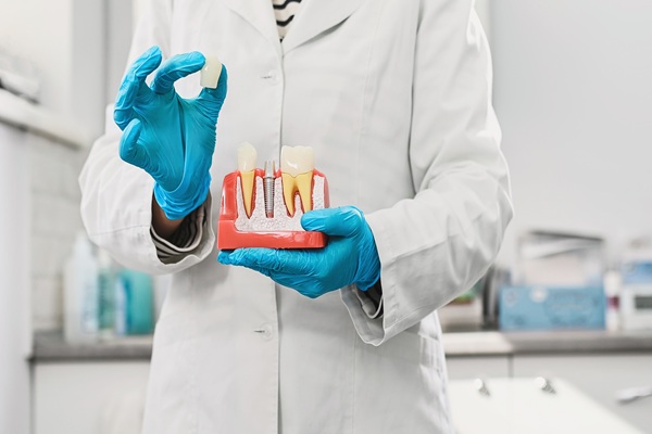 How Natural Does An Implant Crown Look?